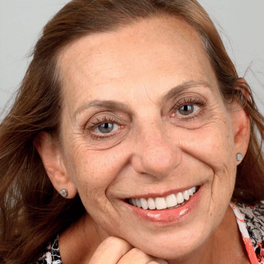 “Adoro todos da Odontologia Espada e amo de paixão a Dra Adriana. Graças a confiança que tenho no trabalho que ela realiza é que consegui fazer o implante na parte superior. Minha vida mudou depois que conheci a Dra Adriana. Hoje me sinto segura e autoconfiante para falar e comer, é outra vida”, Elisabete Mastantuono